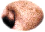 毛穴の「汚れ」「くすみ」「たるみ」などの毛穴トラブル。年齢が重なると、乾燥とともに小じわも増え、毛穴と小じわが繋がった「帯状毛穴」が増え始めます。